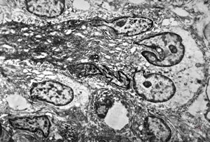 F,41y. | synovial metaplasia - capsule of implantate F,41y. | synovial metaplasia - capsule of implantate